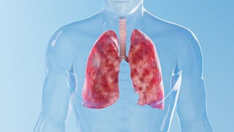 Fast 7 Millionen Erkrankte - Asthma wird jetzt mit Antikörpern behandelt