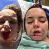 Woman whose entire lip was bitten off by her violent ex boyfriend reveals what she looks like seven years after brutal attack