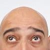 Scientists have uncovered a simple way to cure hair loss