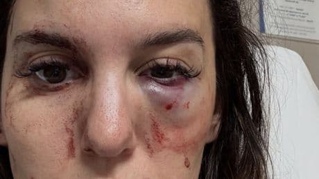 Former Disney star Christy Carlson Romano reveals shocking details about nearly losing her eye after being shot in face