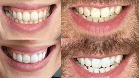 Hours left to get 30% off strips shoppers say gave 'whiter teeth in 7 days for a wedding'