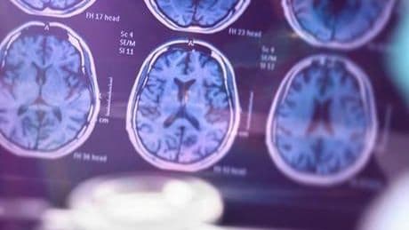 SAĞLIK HABERLERİ: ALZHEIMER HASTALIĞINI ERKEN TEŞHİS EDEN KAN TESTİ