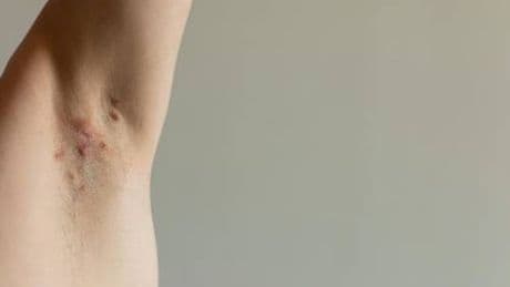 Idrosadenite suppurativa, appello esperti 'sia inserita nel Piano delle cronicità'