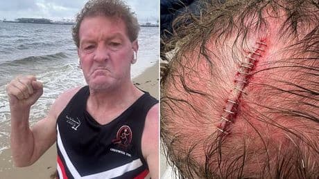 Disgraced footy identity Ricky Nixon shows off gruesome injury that saw him rushed to hospital