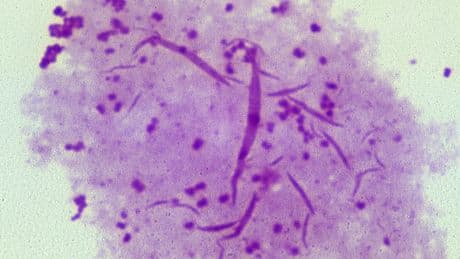 NHS offers world-first vaccine to combat rise in super strain STI