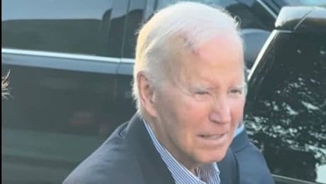 Nach Hautkrebs-OP - Ex-Präsident Joe Biden mit riesiger Narbe auf Kopf