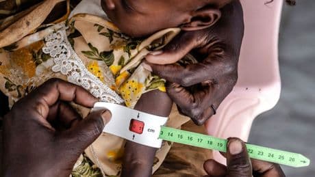 Globale Gesundheit: „Der Körper ist dann dauerhaft auf Mangel getrimmt“