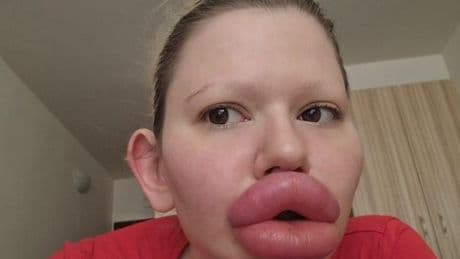 Woman with 'world's biggest lips' looked so different before all the filler