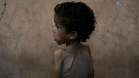 En direct, Gaza : plus de 9 200 enfants ont souffert de malnutrition aiguë pendant le mois de juillet, selon une agence onusienne