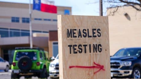 Measles Updates: Over 560 Cases In Texas After Outbreaks Reported In 3 More States