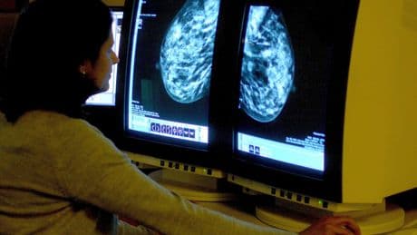Breast cancer breakthrough as new test could revolutionise treatment