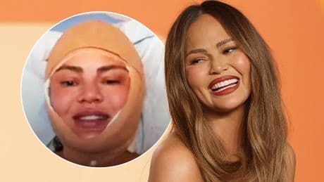 Kopf bandagiert, Stirn genäht - Heftige Beauty-OP bei Model Chrissy Teigen