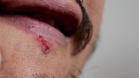 Star-Dermatologin verrät: So werden Sie Lippenherpes endlich los