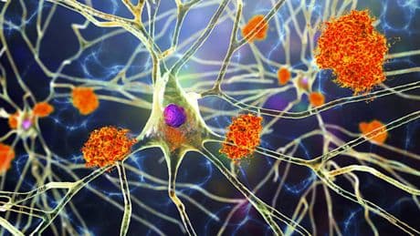 Warum es jetzt Hoffnung für Alzheimer-Patienten gibt