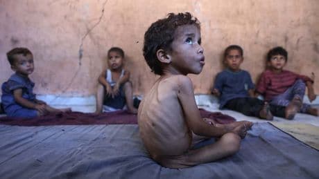 UN says one in five children in Gaza now malnourished