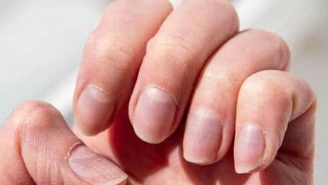 Tırnak sağlığını ihmal etmeyin! Tırnak İçin Hangi Doktora Gidilir? Tırnak Hastalıklarına Hangi Bölüm Bakar?