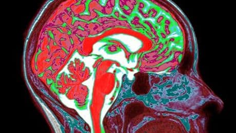 Gedankenlesen mit KI: Implantat ermöglicht begrenztes Mithören innerer Gespräche