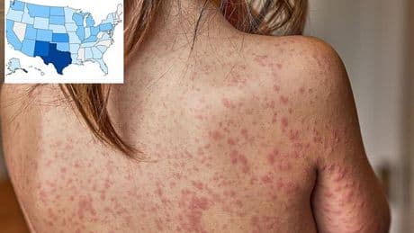 Child dies from measles complication years AFTER recovering from virus