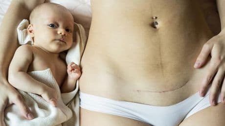 Kaiserschnitt – Wie der Mythos von der natürlichen Geburt immer mehr Frauen verunsichert