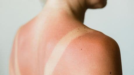 Gesundheitstipps im Check: Quark soll gegen Sonnenbrand helfen – stimmt das?
