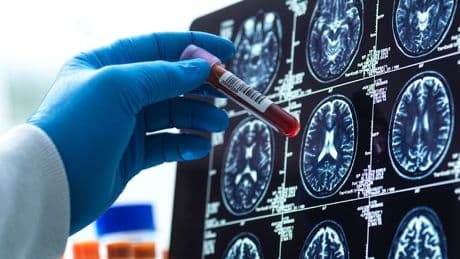 Studie mit Hunderten Gehirnen - Beschleunigt Lithium-Mangel Alzheimer?