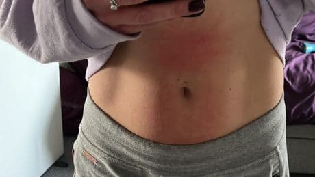 When I broke out in an agonising rash that left me bleeding docs blamed scabies – but 3 common foods were to blame