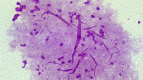 Potential new antibiotic for gonorrhoea as superbugs rise