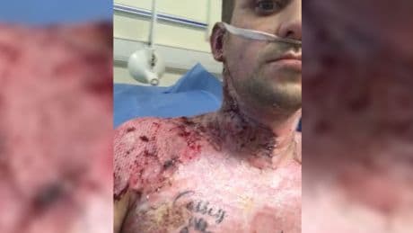 Dad "set on fire" at house party shares video of burnt body from hospital bed