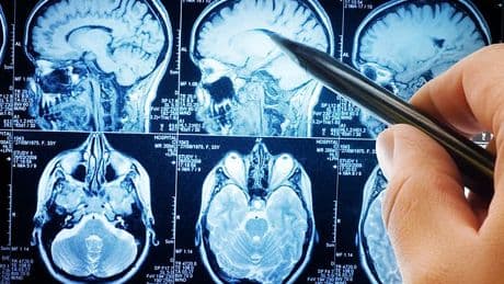 Health problem that affects 1 in 4 could massively increase risk of dementia, experts discover