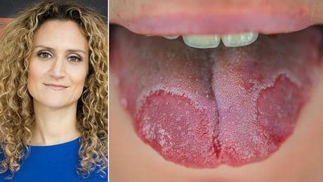 What to do about a crusty white tongue: DR ELLIE reveals what it means about your health, how to get rid of it... and when you should be concerned about cancer