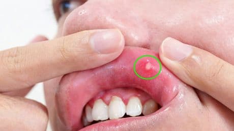Belirtileri umursamadı ama kanserin uyarı işaretiydi: Dilinin alınması gerekiyordu