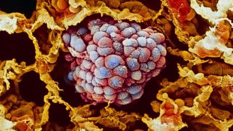 El proyecto de cribado detecta cáncer de pulmón en fase inicial en el 3,2% de los fumadores estudiados
