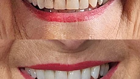 Teeth whitening kit that made a 77-year-old's smile 'look amazing' is 20% off