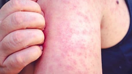 Ancient disease runs rampant with more than 1,000 cases reported and unvaccinated children dying