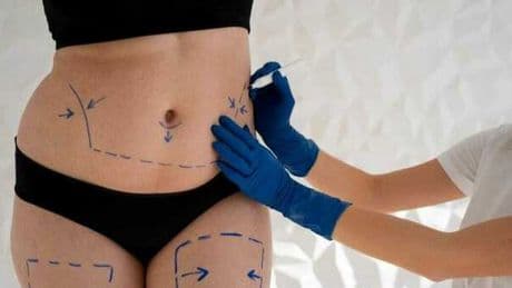 E se il grasso in eccesso forse una risorsa? Il lipofilling diventa la nuova frontiera della medicina estetica