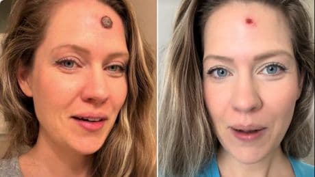 Rachel (33) hat seit 2 Jahren einen "Pickel" - dann folgt die Schockdiagnose