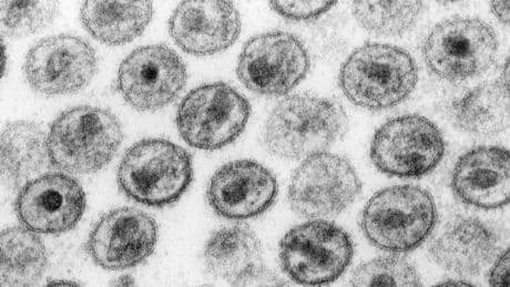 "C'est prometteur": une nouvelle percée dans la recherche sur le VIH reçue avec enthousiasme et prudence