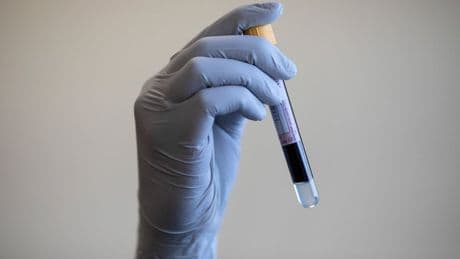NHS to roll out ‘revolutionary’ blood test for lung cancer