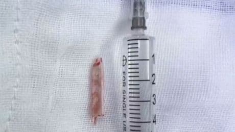 Doctors find thermometer that was lodged inside woman's bottom for 22 years