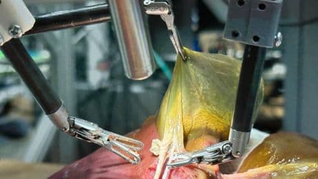 "Comme un chirurgien expérimenté": un robot a effectué une opération en autonomie quasi totale