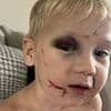 First-day nightmare as boy is left bruised and battered by 'classmate'... then parents watched security footage