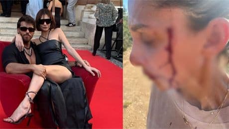 Can Yaman'ın sevgilisi kanlar içinde paylaşım yaptı: Şiddet görüyorum