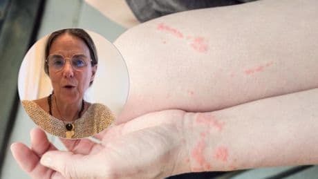 Emma Bellver, doctora: ''Si te pica una medusa, no utilices nunca agua dulce''