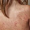 Child dies from measles complication years AFTER recovering from virus