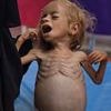 Harrowing images show skeletal Palestinian boy, two, crying out as 11 more die from malnutrition in Gaza, Hamas-run health ministry claims