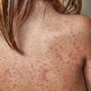 Child dies of measles in Liverpool fueling warnings virus could spread like 'wildfire' amid plunging vaccine rates
