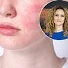 Doctor's guide to fighting rosacea: The cruel unsightly condition can be beaten with little-known treatments that really help, tells DR ELLIE