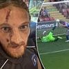 Footballer left with horror facial injury after being kicked in the HEAD by opponent during match