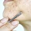 Top dermatologist's urgent warning to those with spots - common remedy could leave you scarred for life