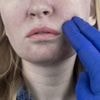 Qu’est-ce que le « visage Ozempic », cet effet indésirable d’une perte de poids très rapide ?